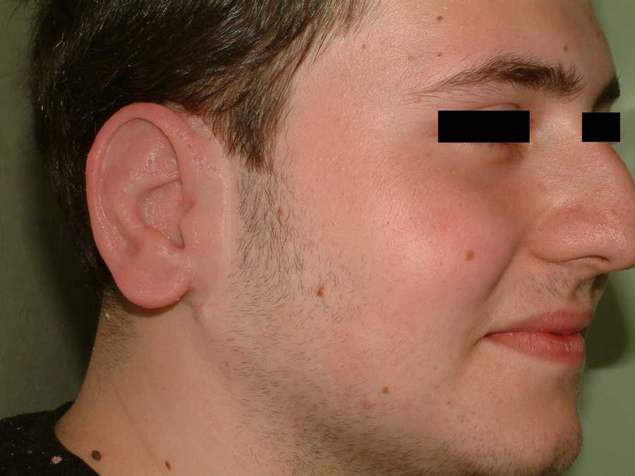 protesi-facciale2