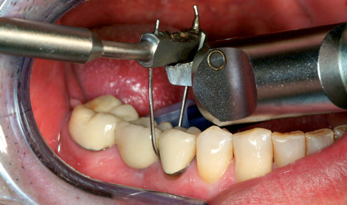trattamento endodontico